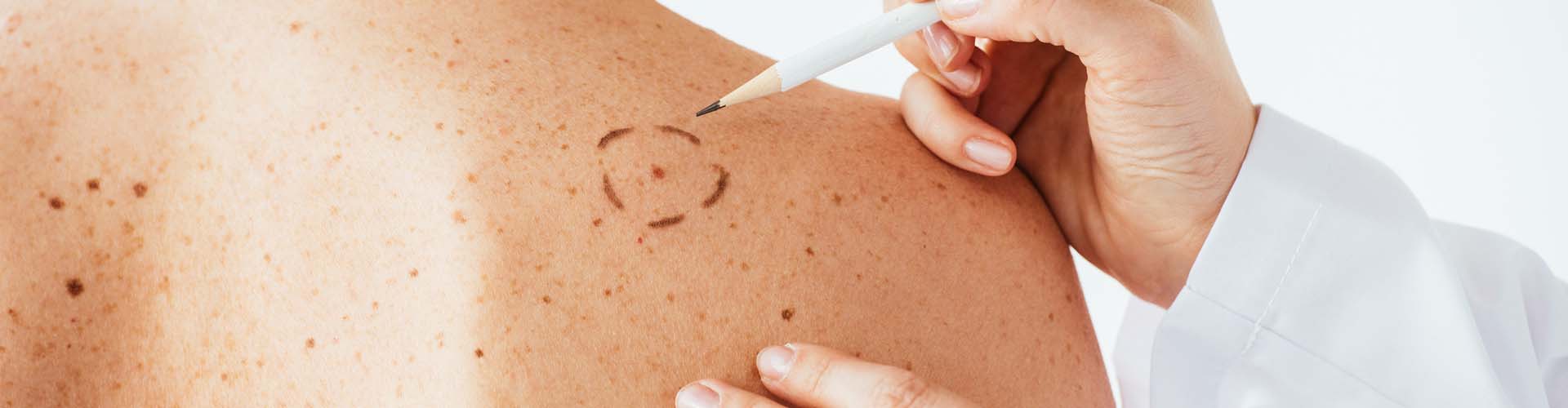 Surveillez vos grains de beauté Quand consulter un dermatologue ? Giropharm